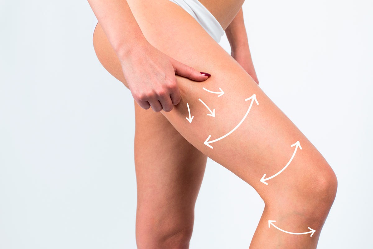 ¿Cómo quitar la flacidez de las piernas sin pasar por el quirófano?