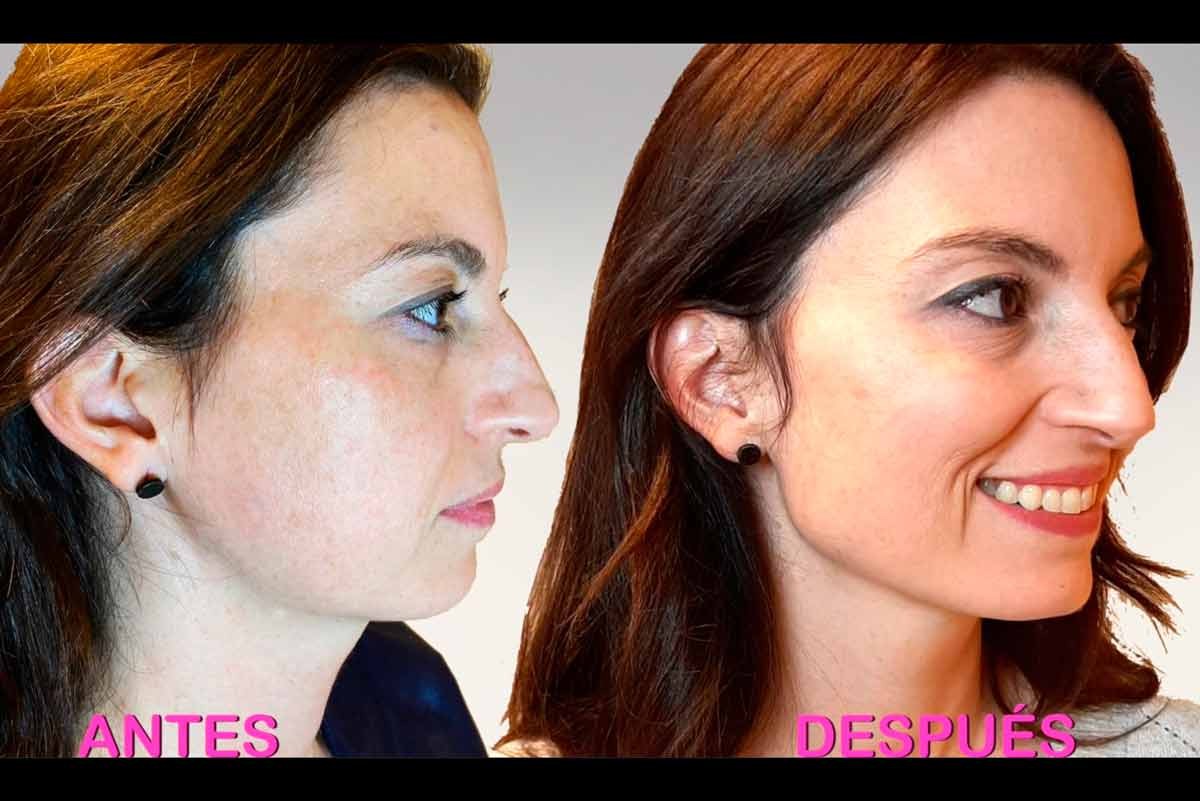 antes y despues óvalo facial