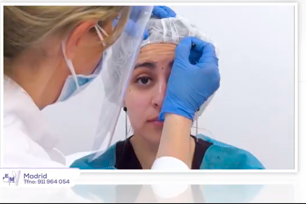 Tratamiento de estética de la mirada en la consulta de medicina estética de la Dra. Carmen Martín en Madrid